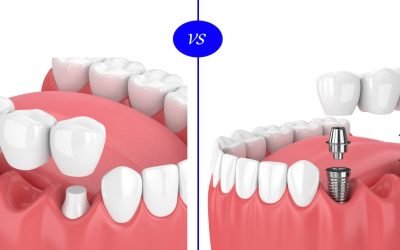 人工植牙與傳統假牙比較