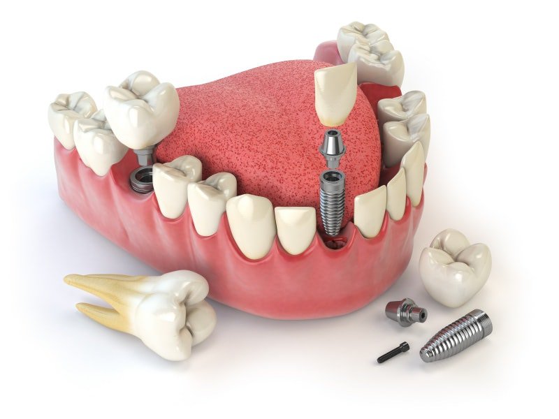 植牙前一定要注意的問題-影響植牙成功的3大因素不可不知